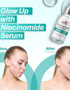 MNT 10% Niacinamide Face Serum with 0.5% Zinc, 30ml – Targets Acne Marks, Blemishes, and Uneven Skin Tone for Clearer Skin