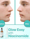 FILZA 10% Niacinamide Face Serum for Acne Marks and Dark Spots, with Zinc and Rice Extract | Fades Blemishes, Reduces Hyperpigmentation & Balances Oil | 30 ml
