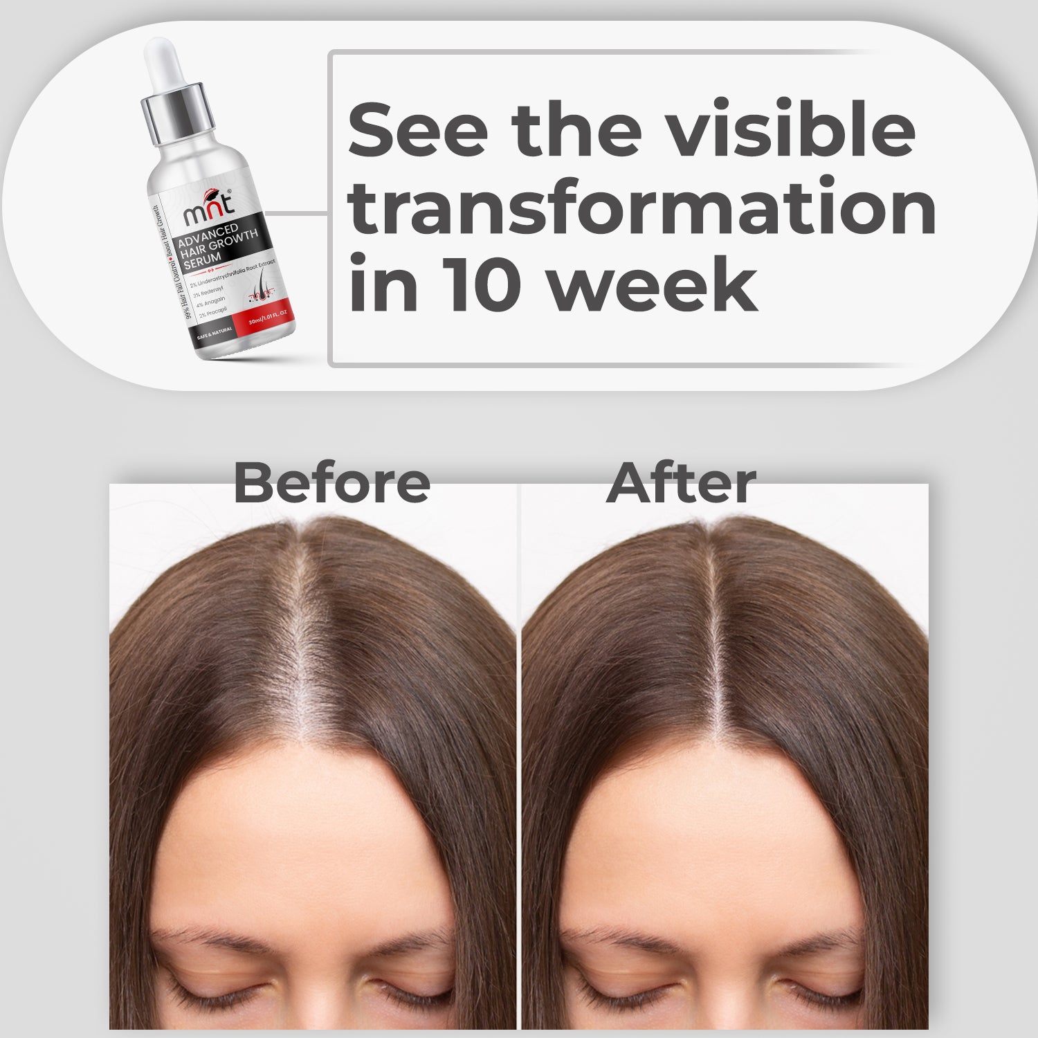 MNT Advanced Hair Growth Serum with 2% Lindera Strychnifolia 3% Redensyl, 4% Anagain, 2% Procapil | Hair Growth Serum for Scalp | Hair Growth Serum for Women & Men | 30 ml