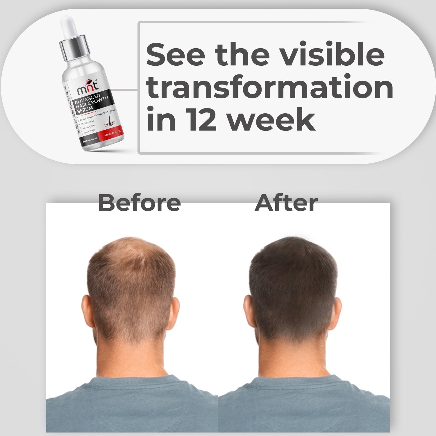 MNT Advanced Hair Growth Serum with 2% Lindera Strychnifolia 3% Redensyl, 4% Anagain, 2% Procapil | Hair Growth Serum for Scalp | Hair Growth Serum for Women & Men | 30 ml