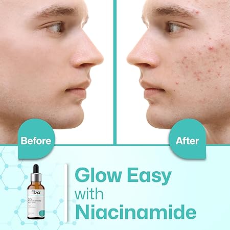 FILZA 10% Niacinamide Face Serum for Acne Marks and Dark Spots, with Zinc and Rice Extract | Fades Blemishes, Reduces Hyperpigmentation & Balances Oil | 30 ml