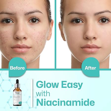 FILZA 10% Niacinamide Face Serum for Acne Marks and Dark Spots, with Zinc and Rice Extract | Fades Blemishes, Reduces Hyperpigmentation & Balances Oil | 30 ml